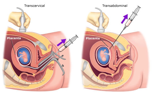 chorionic villus sampling2